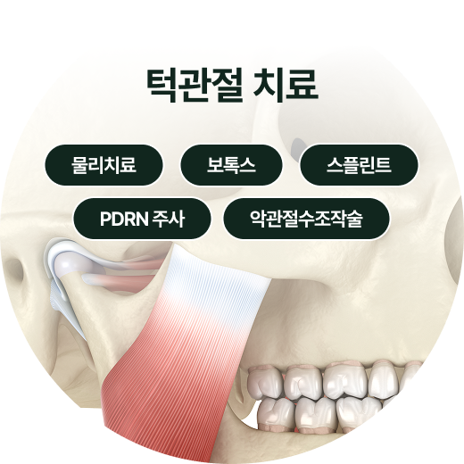 임플란트