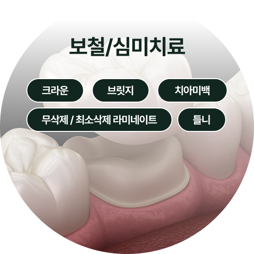 사랑니 발치
